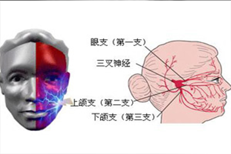 牙疼当心三叉神经痛来袭