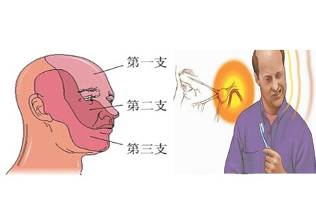 有一种“痛”叫三叉神经痛