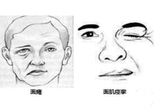 教你如何区分面瘫和面肌痉挛